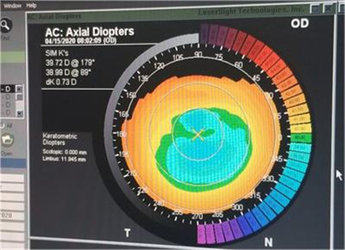 眼底地形图