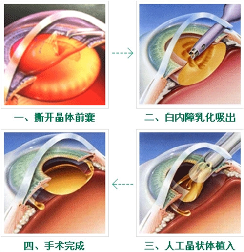 大连做白内障手术多少钱？传统手术方式2000+ 双焦点晶体置换21000+