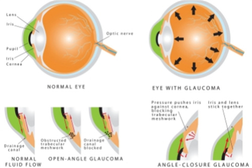 青光眼结构图