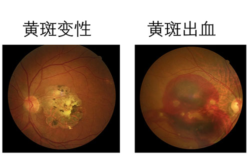 在线回复:眼底病包括哪些疾病?带你一篇了解飞蚊症/黄斑病变/视乳头炎究竟是什么!