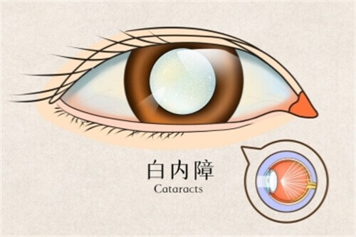 白内障折叠形人工晶体价格表！白内障晶体价格从低到高都有~