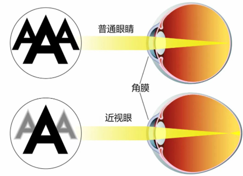 近视眼镜与正常眼睛视物区别