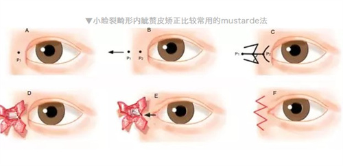 小睑裂综合征手术费用大概多少？小睑裂手术难度大吗？小睑裂手术详细了解！