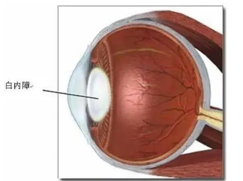 治疗白内障