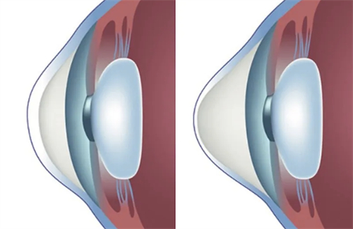 正常的角膜和圆锥角膜