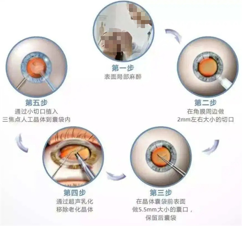白内障飞秒激光手术有副作用吗？请知道的人来说一下吧！