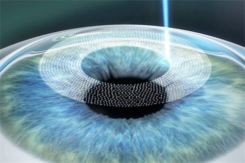 蔡司4.0什么时候出来?2024年6月微创全飞秒4.0-VISULYZE技术引进中国大陆!