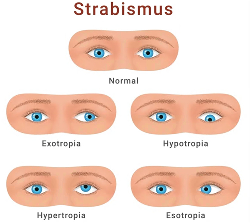 斜视手术不同症状