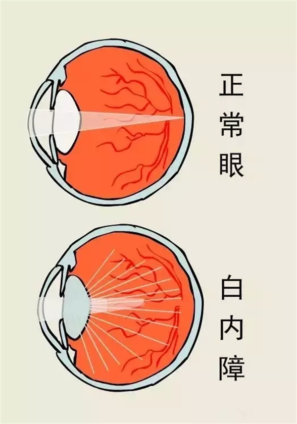 重庆地区眼科收费标准表！近视8k 白内障3k 散光2k 青光眼2k