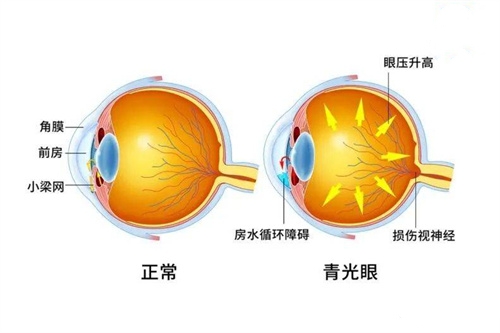 青光眼与正常眼对比图