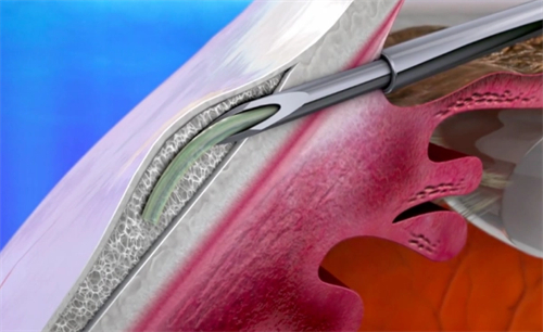 青光眼激光手术价格是多少?激光手术利弊是什么?可以维持多长时间?