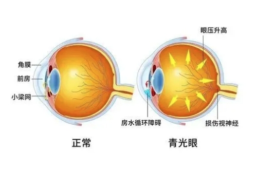 正常眼睛与青光眼概念对比图