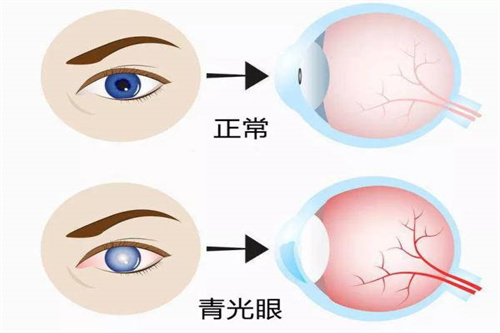 正常的眼睛与青光眼对比素材