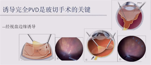 玻璃体视网膜手术是什么，对玻璃体和视网膜进行干预可改善视力！