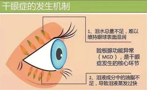 干眼症的发生机制