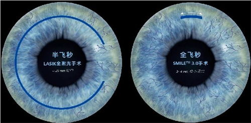 2024无锡飞秒激光手术价格表，内含无锡做半飞秒、全飞秒、ICL晶体植入的价格