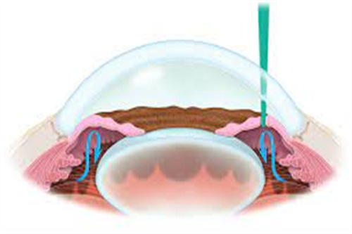 虹膜切除术 青光眼