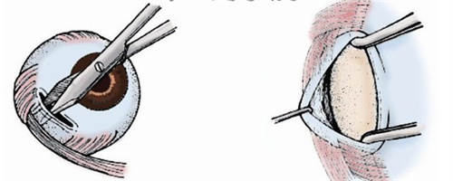 斜视下斜肌手术