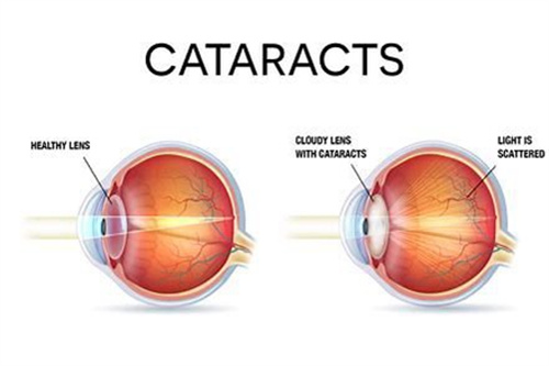健康眼与白内障眼对比