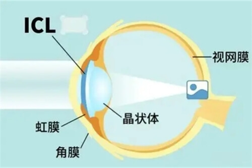 icl晶体植入术眼睛位置示意图