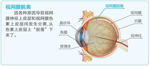 视网膜脱落示意图