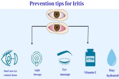 预防虹膜炎