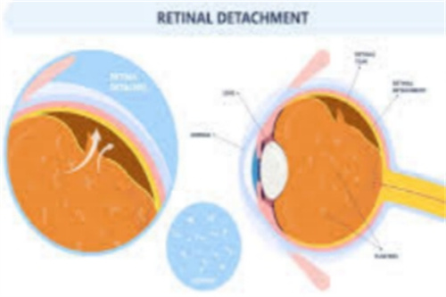 视网膜脱落手术费用要多少？做视网膜脱落手术修复手术均价在8000-3万不等！