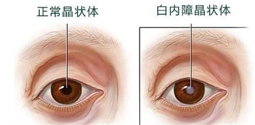 常州白内障免费政策来了，白内障患者可领取补贴，部分可免费手术！