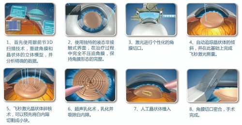 超声乳化白内障手术细节