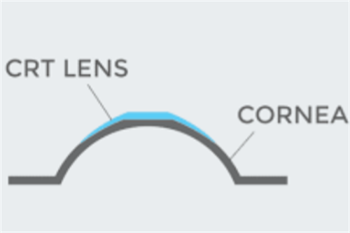 CRT角膜塑形镜示意图