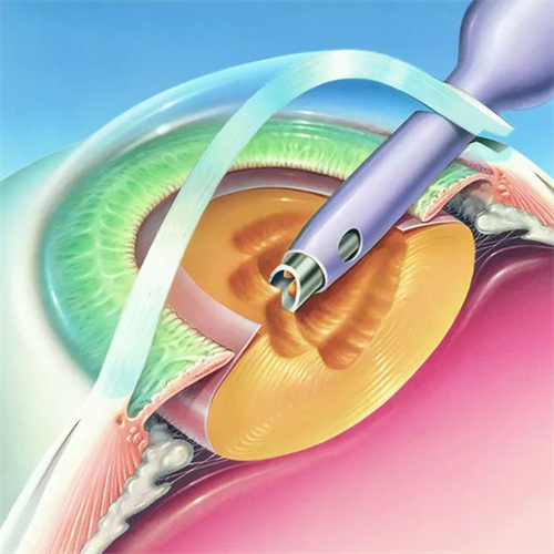 超声乳化白内障吸除