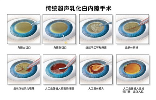 超声乳化白内障手术