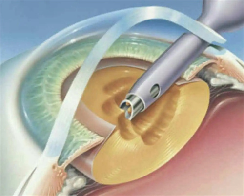 白内障超声乳化手术图片
