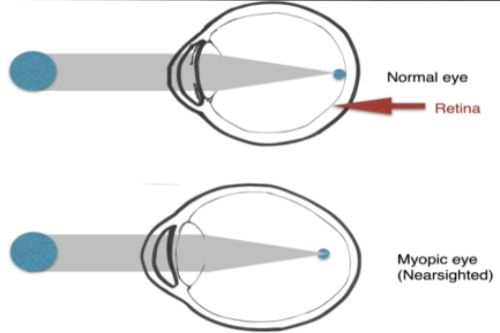 正常眼与近视眼对比