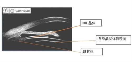 PRL晶体植入术原理