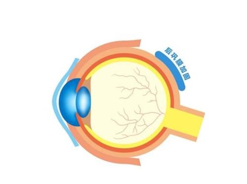 后巩膜加固手术能治疗近视吗，可以有效控制近视度数的增长！