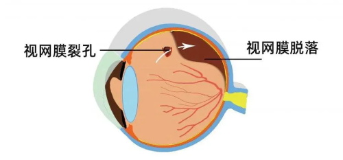 视网膜脱落裂孔示意图