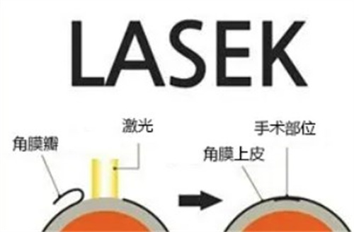 LASEK手术