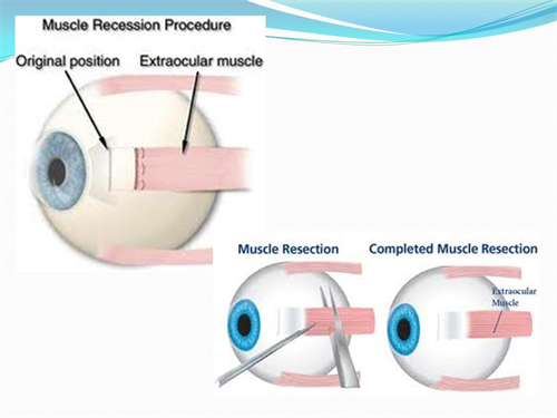 斜视手术原理图示