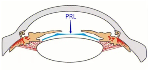PRL晶体植入术放置位置