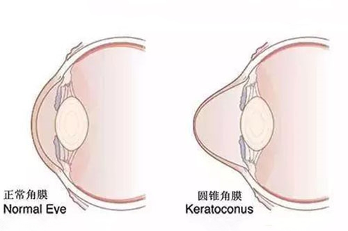 圆锥角膜与正常眼睛展示图