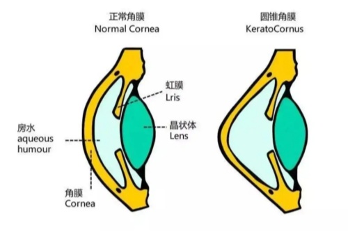 正常角膜与圆锥角膜卡通对比图