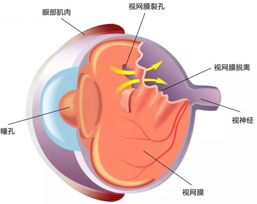 视网膜脱落展示图