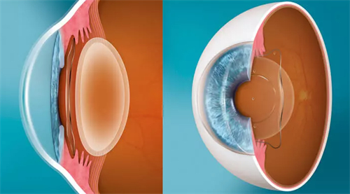 玉溪艾维眼科晶体植入怎么样?文章分享艾维眼科ICL优势及口碑