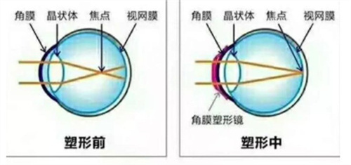 角膜塑形镜塑形时