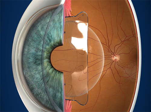 进行晶体植入的眼睛