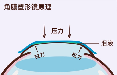 角膜塑形镜原理 角膜塑形镜原理