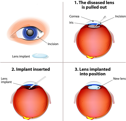 晶体植入手术过程