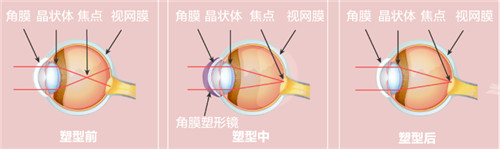 角膜塑形原理