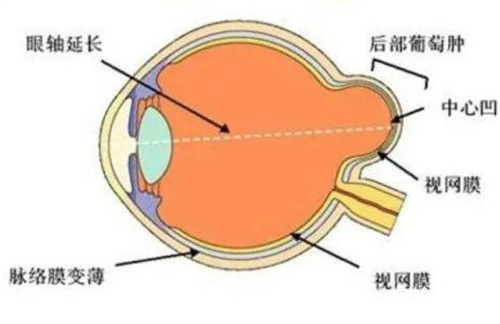 后巩膜葡萄肿
